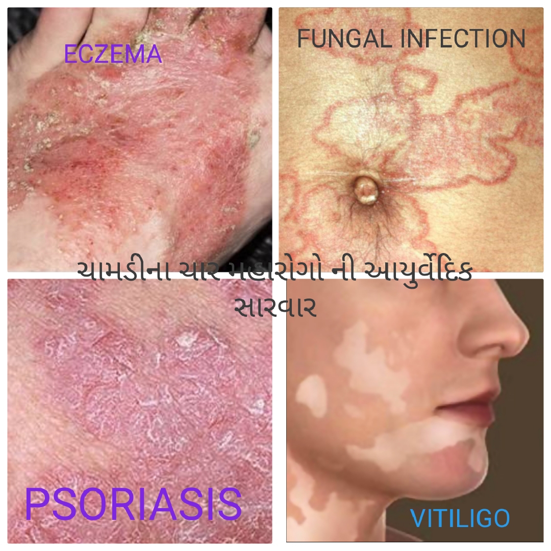 Ayurvedic Treatment for Psoriasis